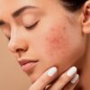 Vaincre l’acné pour avoir une peau parfaite