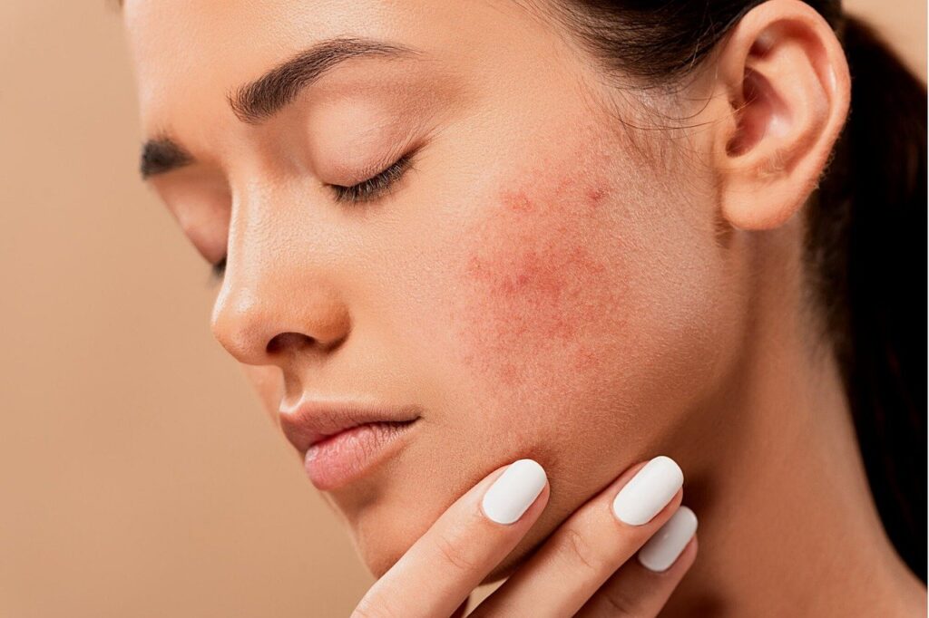 Vaincre l’acné pour avoir une peau parfaite