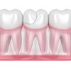 Dents cassées : causes et traitements courants